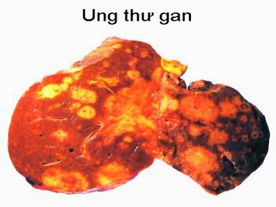 tinh-trang-ung-thu-gan.jpg