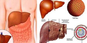 Bi-mac-benh-virus-viem-gan-B-co-chua-khoi-han-duoc-khong-1