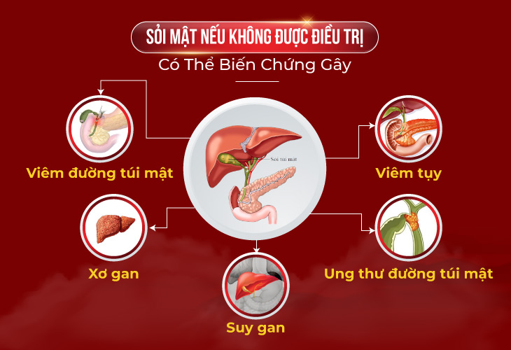 Sỏi mật nếu không được điều trị sẽ gây ra những biến chứng nguy hiểm 