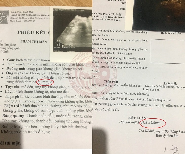 Kết quả siêu âm từ bệnh nhân sỏi mật sau liệu trình 3 táng sử dụng Nhất Nam Tiêu Thạch Khang