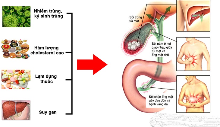 Những biến chứng nguy hiểm của sỏi mật 