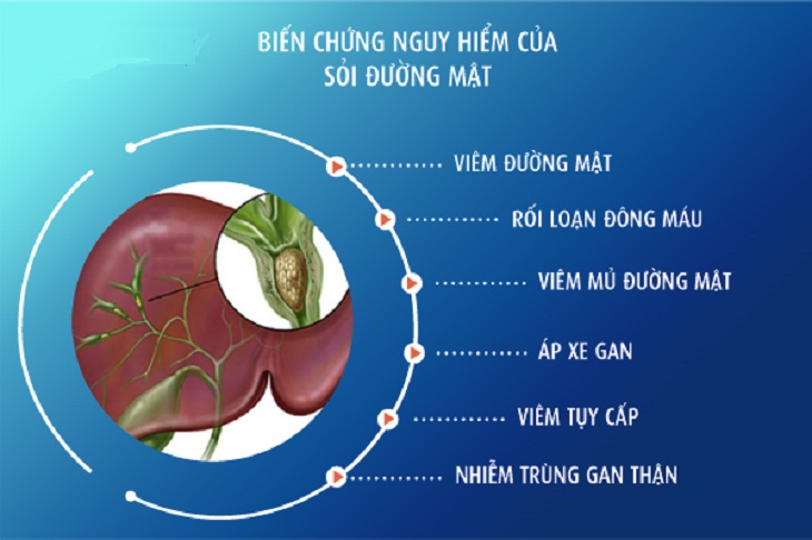 những những biến chứng nguy hiểm của sỏi mật 