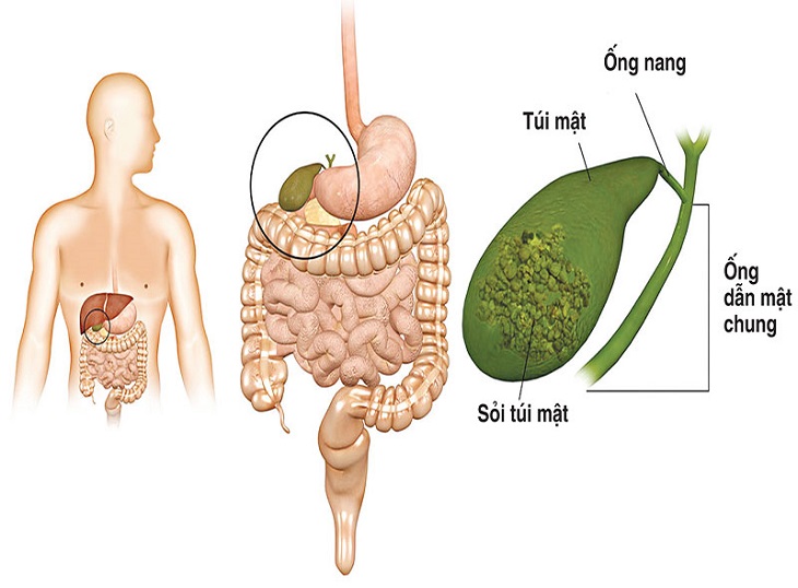 Viêm túi mật cấp là biến chứng nguy hiểm của bệnh sỏi mật