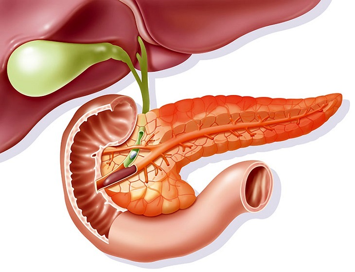 Sỏi mật gây ra biến chứng viêm tụy cấp